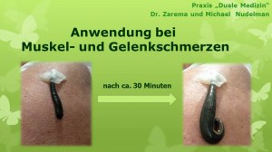 Blutegel-Therapie3